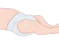 Illustration av ett barns ben och blöja, visar var vaccin ges vid 3 månader.
