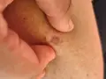 Nära hud med små, mörka prickar och en rödaktig fläck. En tumme och ett finger håller försiktigt i huden.