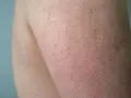 Närbild på hud med små röda prickar, typiskt för keratosis pilaris hos barn.