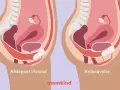Illustration av bäckenbotten i avslappnat tillstånd och vid knipövning. Kan hjälpa vid tryck neråt och ont i blygdbenet.