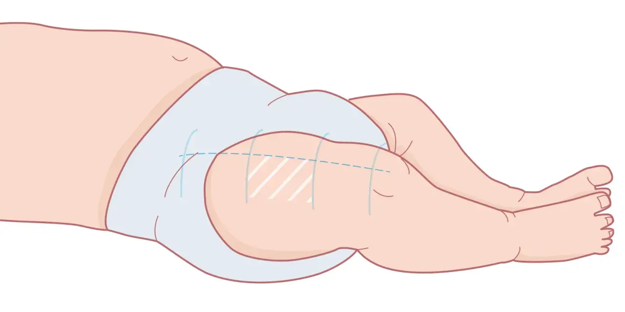 Illustration av ett barns ben och blöja, visar var vaccin ges vid 3 månader.