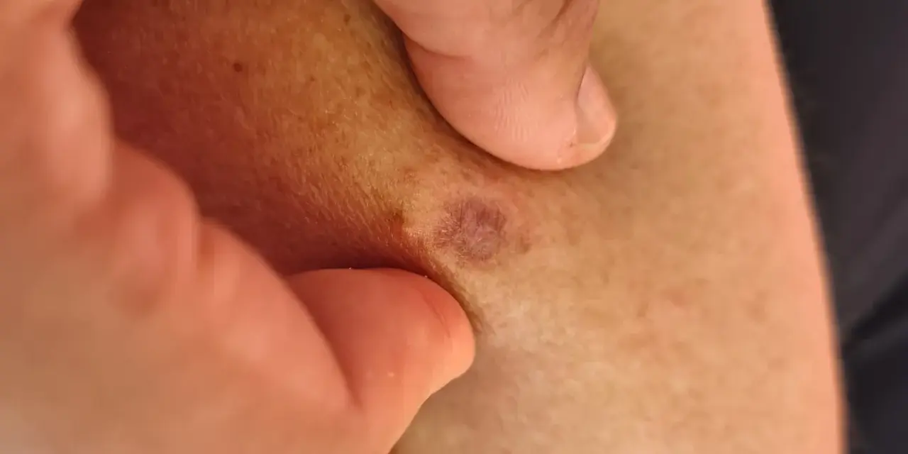 Nära hud med små, mörka prickar och en rödaktig fläck. En tumme och ett finger håller försiktigt i huden.