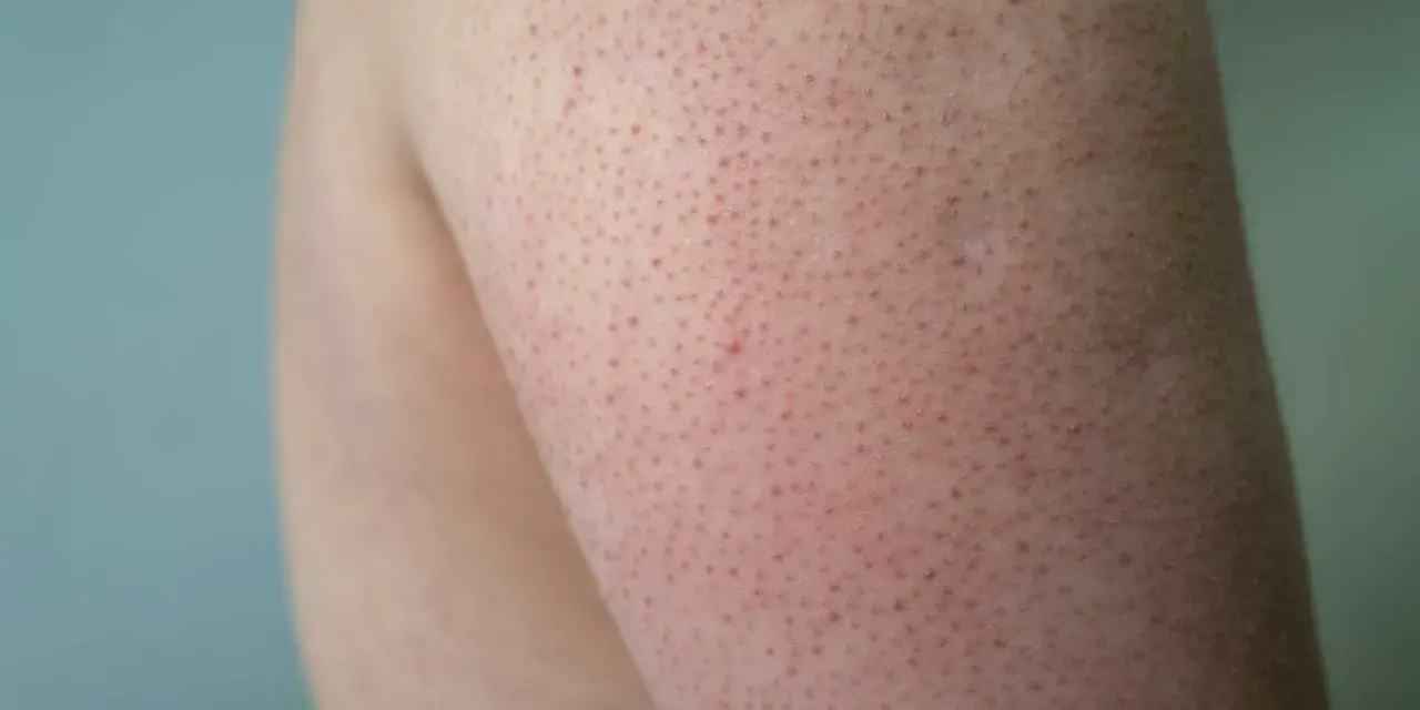 Närbild på hud med små röda prickar, typiskt för keratosis pilaris hos barn.