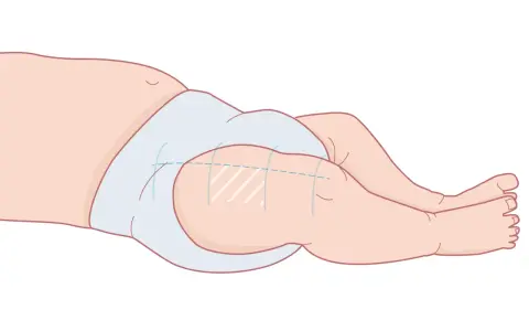 Illustration av ett barns ben och blöja, visar var vaccin ges vid 3 månader.
