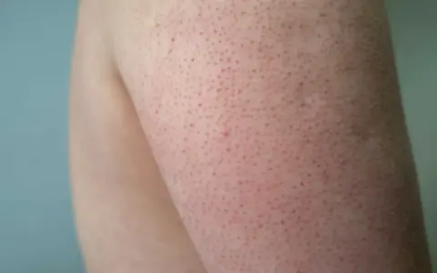 Närbild på hud med små röda prickar, typiskt för keratosis pilaris hos barn.