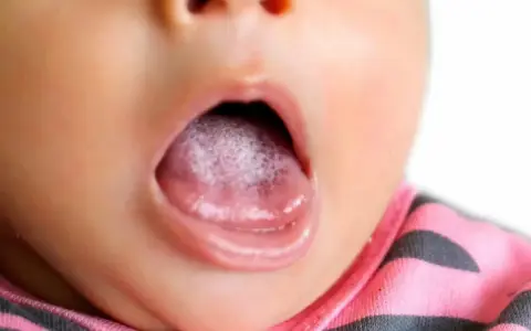 Ett litet barns mun med en vitbelagd tunga, kanske en liten torsk bebis som behöver lite omvårdnad.
