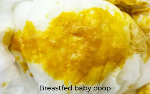 Close-up of bright yellow, seedy breastfed baby poop on a white diaper.