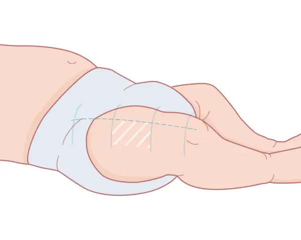 Illustration av ett barns ben och blöja, visar var vaccin ges vid 3 månader.