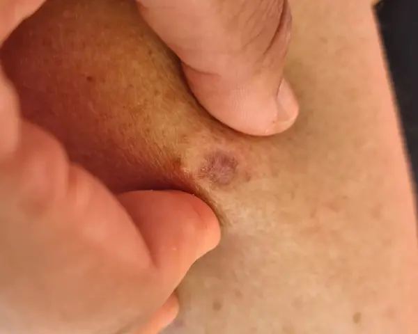 Nära hud med små, mörka prickar och en rödaktig fläck. En tumme och ett finger håller försiktigt i huden.
