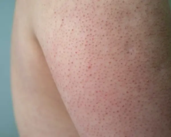 Närbild på hud med små röda prickar, typiskt för keratosis pilaris hos barn.