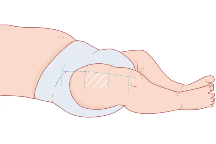 Illustration av ett barns ben och blöja, visar var vaccin ges vid 3 månader.