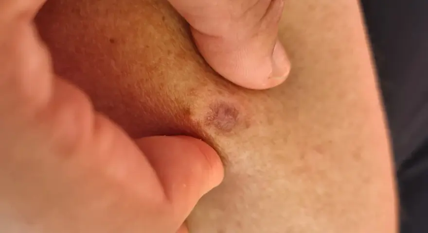 Nära hud med små, mörka prickar och en rödaktig fläck. En tumme och ett finger håller försiktigt i huden.