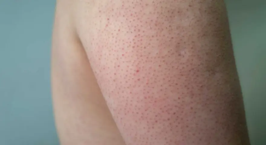 Närbild på hud med små röda prickar, typiskt för keratosis pilaris hos barn.