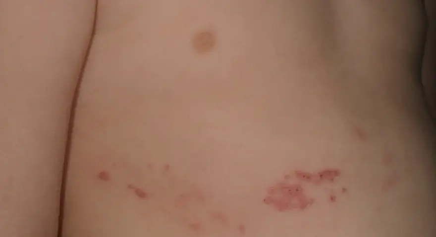 Barnets hud visar röda utslag och blåsor, typiska virusprickar hos barn.