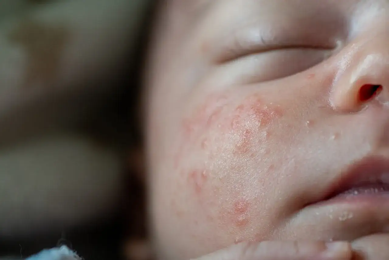 Närbild på en bebis kind med röda utslag och små vita prickar, troligtvis hormonplitor bebis.