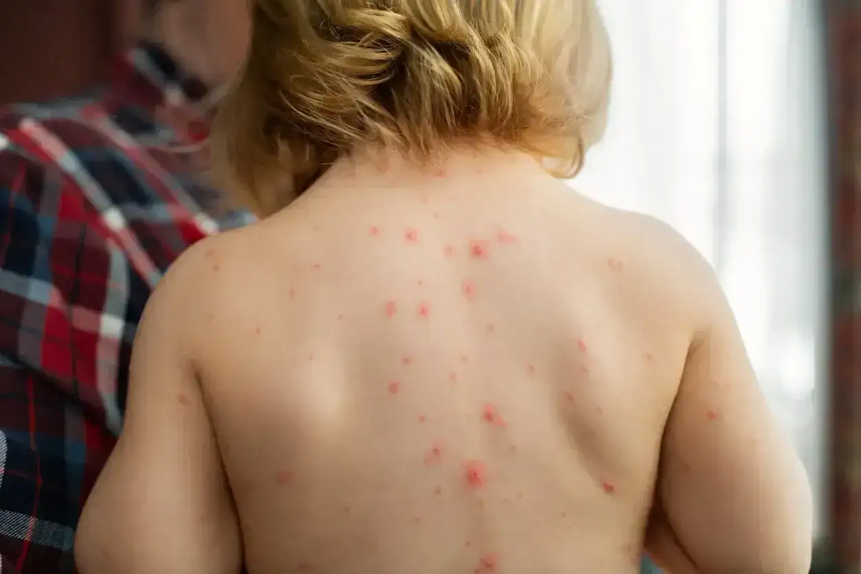Barnets rygg täckt av röda virusprickar. En person i rutig skjorta syns i bakgrunden.