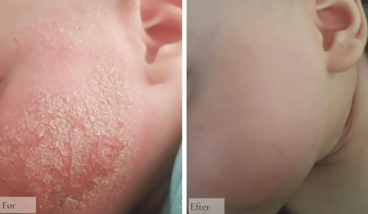 F&ouml;re och efter-bilder som visar en bebis med sv&aring;rt eksem p&aring; kinden som blivit mycket b&auml;ttre.