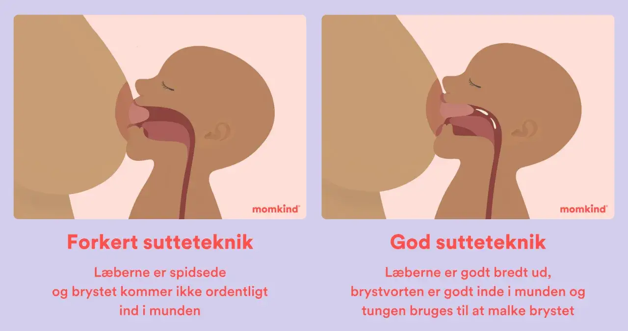 Illustrationer visar felaktig och korrekt amningsteknik. Vid fel teknik är läpparna spetsiga och tungan kan vara för kort, ett så kallat kort tungband.