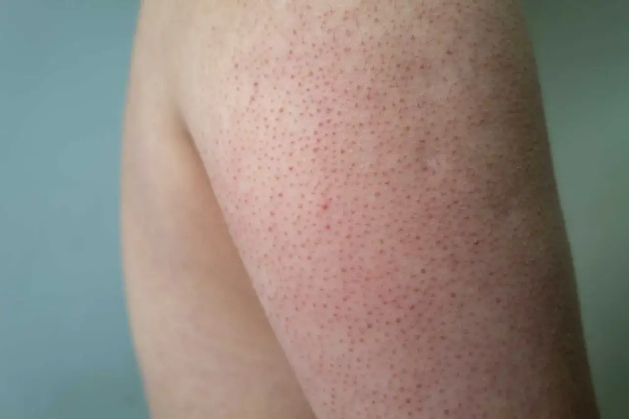 Närbild på arm med keratosis pilaris hos ett barn. Små röda prickar syns tydligt på huden.