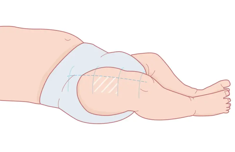 Illustration av ett barns ben och blöja, visar var vaccin ges vid 3 månader.